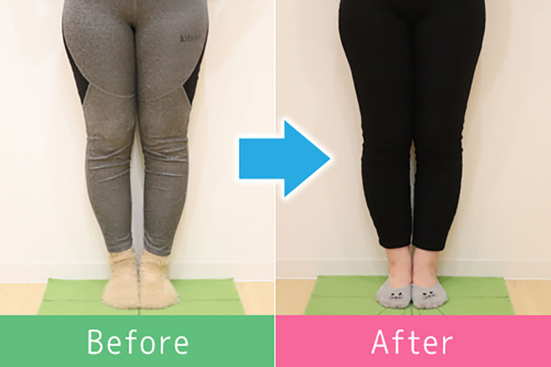美脚 ビフォーアフター2